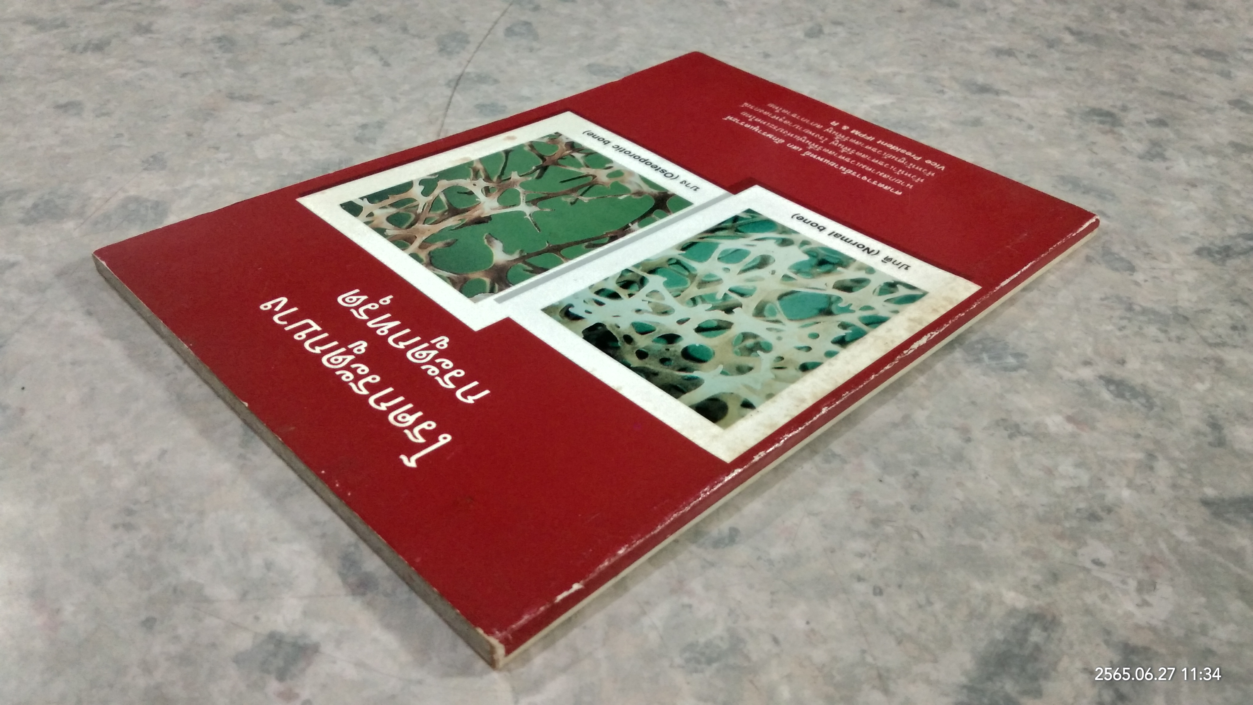 โรคกระดูกบาง กระดูกทรุด / ศจ.นายแพทย์ เสก อักษรานุเคราะห์