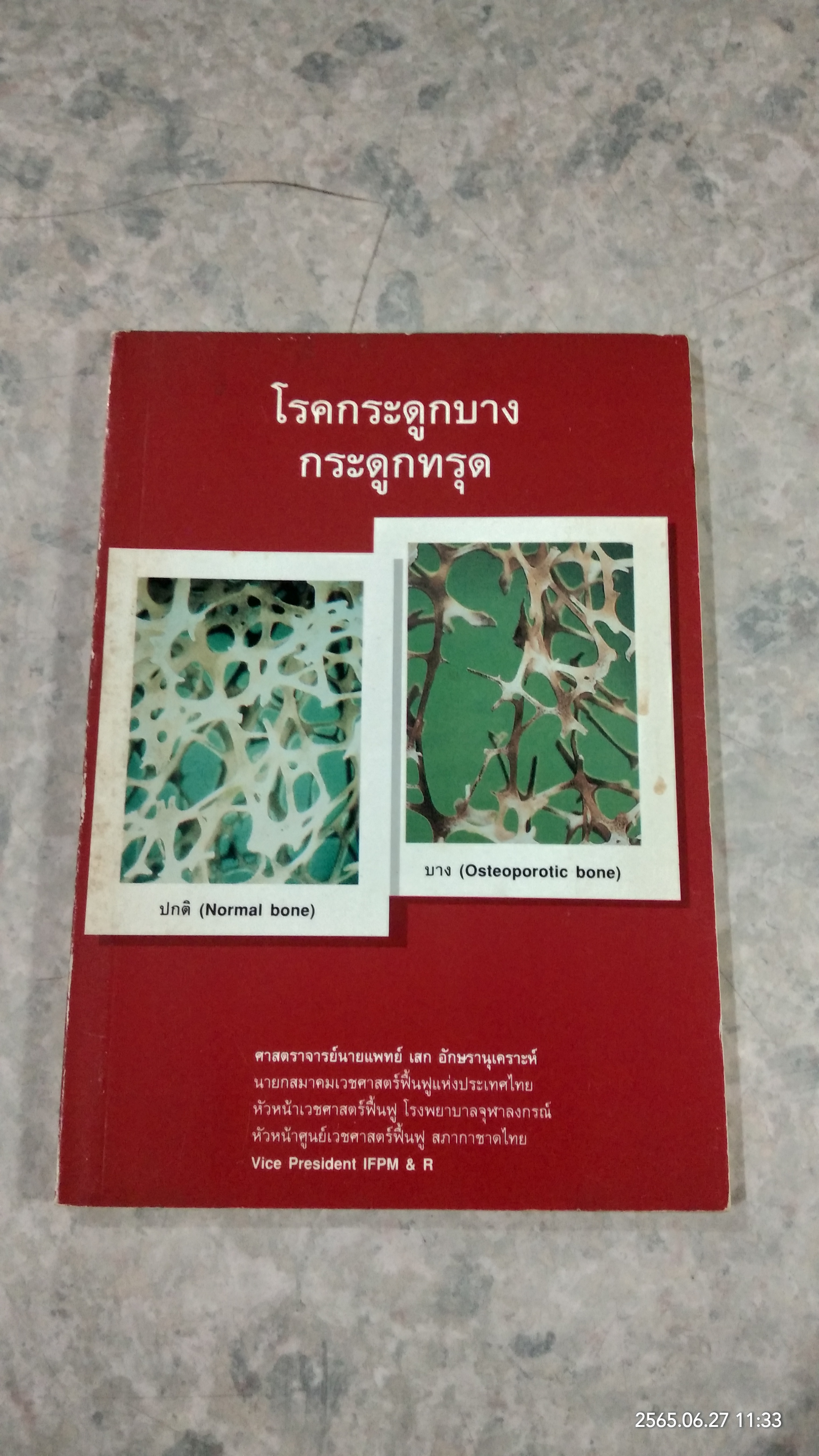 โรคกระดูกบาง กระดูกทรุด / ศจ.นายแพทย์ เสก อักษรานุเคราะห์