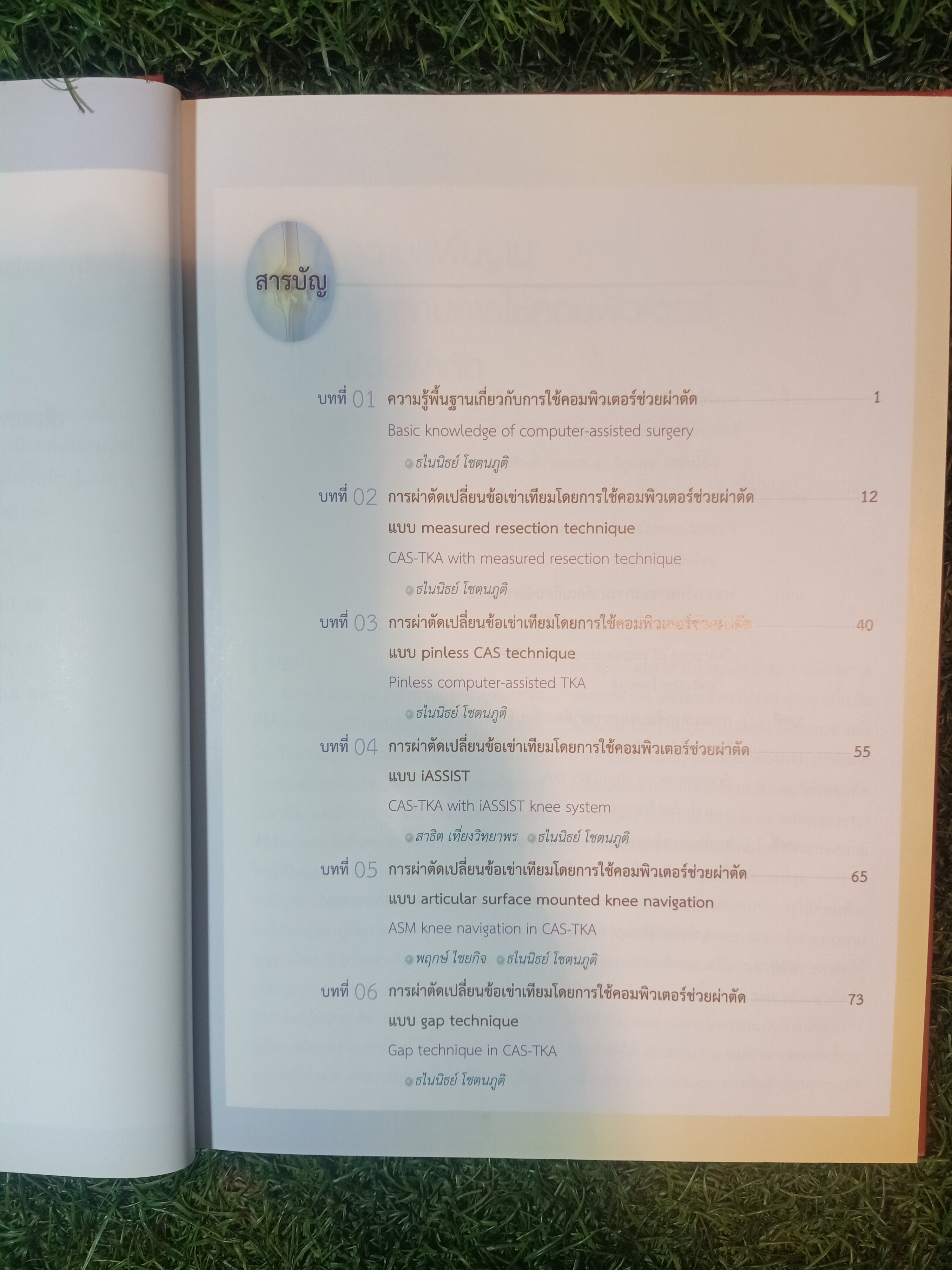 การผ่าตัดเปลี่ยนข้อเข่าเทียม โดยการใช้คอมพิวเตอร์ช่วยผ่าตัด / ธไนนิธย์ โชตนภูมิ